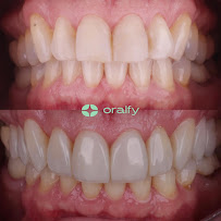 Oralfy Teresina - Implantes • Facetas • Invisalign • Próteses