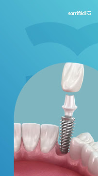 Sorrifácil - Teresina Centro Implantes, Prótese Protocolo, Reabilitação Oral e Lentes de Contato