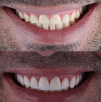 Clínica Bethânia Luna - Facetas de Resina em João Pessoa