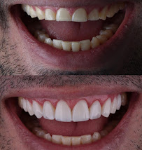Clínica Bethânia Luna - Facetas de Resina em João Pessoa
