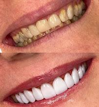 Clínica Bethânia Luna - Facetas de Resina em João Pessoa