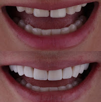 Clínica Bethânia Luna - Facetas de Resina em João Pessoa