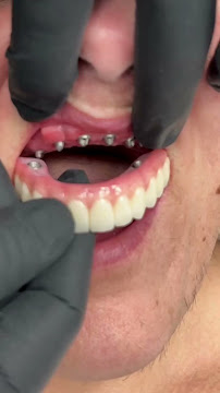 VITA Odontologia | Implantes - Lentes de Contato - Próteses Fixas