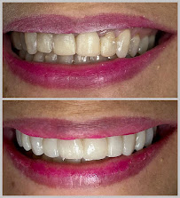Saúde Center Odontologia | Implante dentário | Dentista | Implantes | Unidade Delfino Magalhães