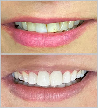 Saúde Center Odontologia | Implante dentário | Dentista | Implantes | Unidade Delfino Magalhães