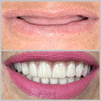 Saúde Center Odontologia | Implante dentário | Dentista | Implantes | Unidade Delfino Magalhães in Montes Claros, Brazil