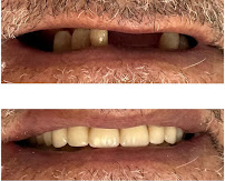 Saúde Center Odontologia | Implante dentário | Dentista | Implantes | Unidade Delfino Magalhães