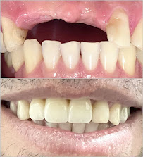 Saúde Center Odontologia | Implante dentário | Dentista | Implantes | Unidade Delfino Magalhães