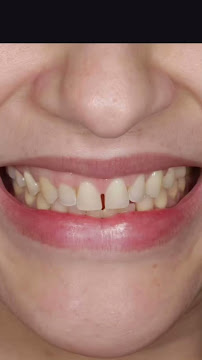 Obno Odontologia - Implantes Dentários em Montes Claros