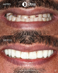 Obno Odontologia - Implantes Dentários em Montes Claros