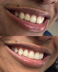 Dra. Aritana Lopes Severo | Lentes de Resina e Periodontia | Pelotas-RS