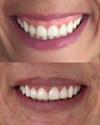 Dra. Aritana Lopes Severo | Lentes de Resina e Periodontia | Pelotas-RS