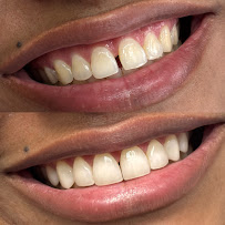 Dra. Aritana Lopes Severo | Lentes de Resina e Periodontia | Pelotas-RS