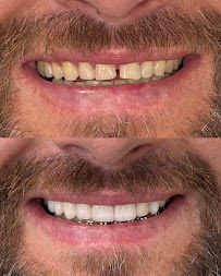 Dra. Aritana Lopes Severo | Lentes de Resina e Periodontia | Pelotas-RS