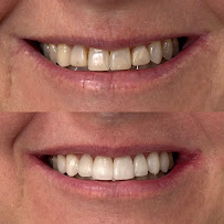 Dra. Aritana Lopes Severo | Lentes de Resina e Periodontia | Pelotas-RS