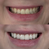 Dra. Aritana Lopes Severo | Lentes de Resina e Periodontia | Pelotas-RS