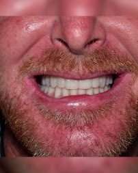 Odontologia por Especialistas Implantes Dentales