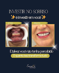 Encanttá Odontologia | Implante Dentário | Dentista | Alto | Piracicaba - SP