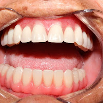 Implantes Dentários | Próteses Fixas | Lima Clínica Odontológica Dentista em Bauru