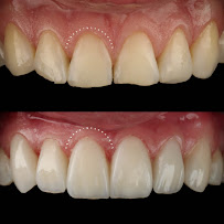 Dra Vanessa Bitencourt - Odontologia estética (Lente de contato dental e faceta de porcelana)
