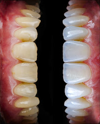 Dra Vanessa Bitencourt - Odontologia estética (Lente de contato dental e faceta de porcelana)