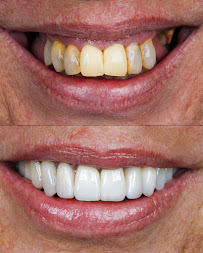 Dra Vanessa Bitencourt - Odontologia estética (Lente de contato dental e faceta de porcelana)