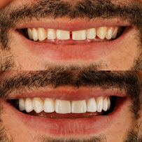 Dra Vanessa Bitencourt - Odontologia estética (Lente de contato dental e faceta de porcelana)
