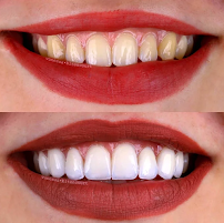 Dra Vanessa Bitencourt - Odontologia estética (Lente de contato dental e faceta de porcelana)