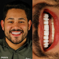 Dra Vanessa Bitencourt - Odontologia estética (Lente de contato dental e faceta de porcelana)