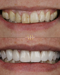 Dra Vanessa Bitencourt - Odontologia estética (Lente de contato dental e faceta de porcelana)