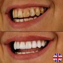 Dra Vanessa Bitencourt - Odontologia estética (Lente de contato dental e faceta de porcelana)