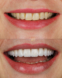 Dra Vanessa Bitencourt - Odontologia estética (Lente de contato dental e faceta de porcelana)