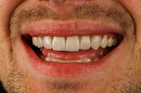 Dra Vanessa Bitencourt - Odontologia estética (Lente de contato dental e faceta de porcelana)