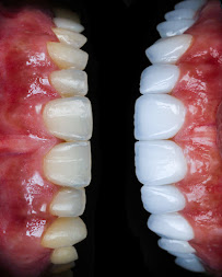Dra Vanessa Bitencourt - Odontologia estética (Lente de contato dental e faceta de porcelana)