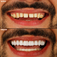 Dra Vanessa Bitencourt - Odontologia estética (Lente de contato dental e faceta de porcelana)