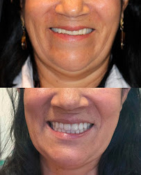 Vila A Odontologia | Implantes Dentários em Foz do Iguaçu