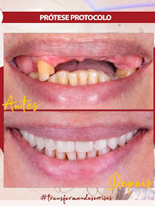 Design Oral: Dentista, Facetas, Clareamento, Implantes, Próteses em Cascavel PR