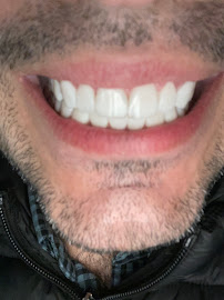 Clínica Bitencourt - Facetas de Resina e Odontologia Estética