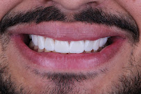 Clínica Bitencourt - Facetas de Resina e Odontologia Estética