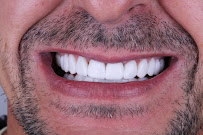 Clínica Bitencourt - Facetas de Resina e Odontologia Estética
