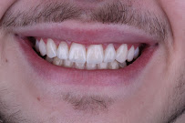 Clínica Bitencourt - Facetas de Resina e Odontologia Estética