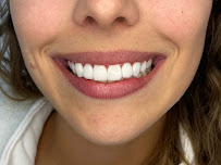 Clínica Bitencourt - Facetas de Resina e Odontologia Estética