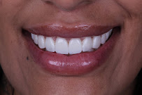 Clínica Bitencourt - Facetas de Resina e Odontologia Estética
