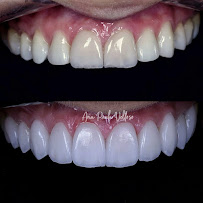 Velloso Odontologia - Facetas em Vitória