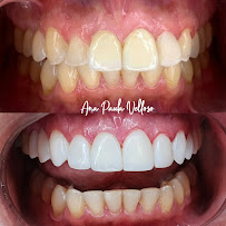 Velloso Odontologia - Facetas em Vitória