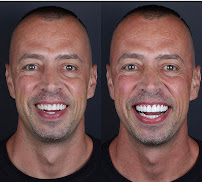 Velloso Odontologia - Facetas em Vitória