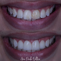 Velloso Odontologia - Facetas em Vitória
