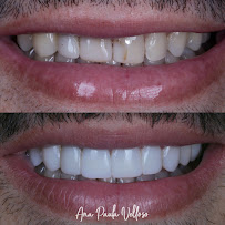 Velloso Odontologia - Facetas em Vitória