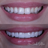 Velloso Odontologia - Facetas em Vitória