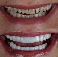 Velloso Odontologia - Facetas em Vitória